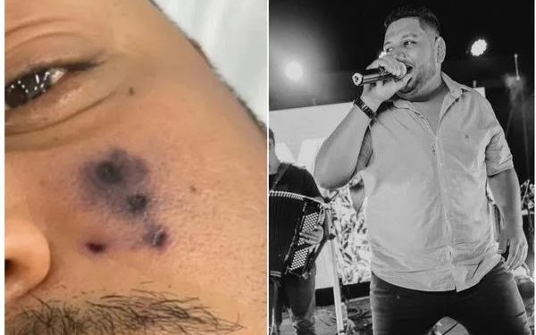 Cantor de forró é picado por aranha, passa mal e morre: ‘Começou a escurecer o rosto’