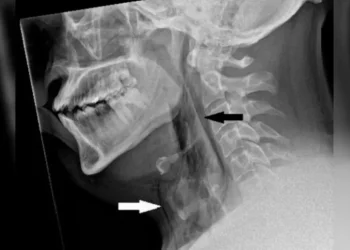 Homem sofre lesão após conter espirros com o nariz apertado e boca fechada