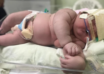 Lembra do bebê gigante de 7,3 kg de Parintins? Veja como ele está hoje, com 1 ano