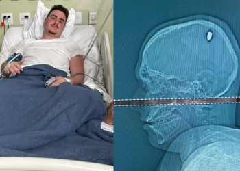 Após quatro dias, estudante descobre que foi vítima de bala perdida e levou tiro na cabeça