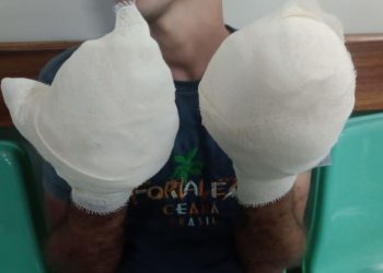 Homem tem os dedos arrancados por líder do tráfico na Compensa ao ser flagrado roubando