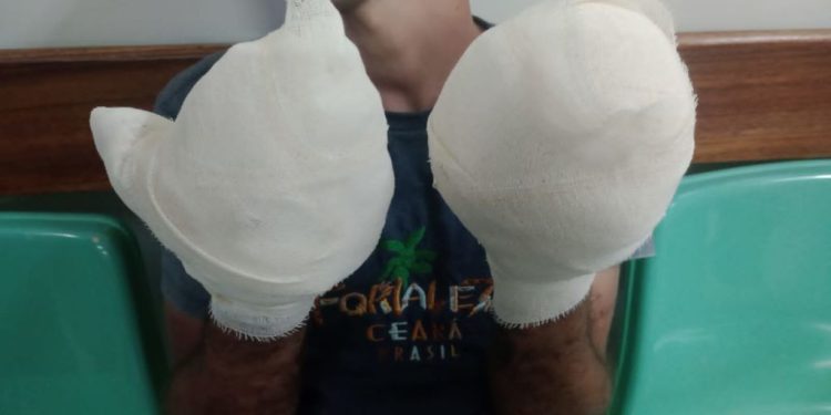 Homem tem os dedos arrancados por líder do tráfico na Compensa ao ser flagrado roubando