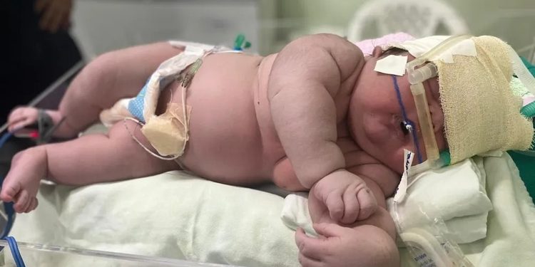 Bebê que que viralizou por nascer com 7,4 quilos completa 1 ano