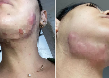 Mulheres acusam dentista de gerar infecções no rosto dela após procedimentos estéticos