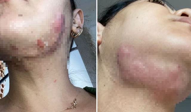 Mulheres acusam dentista de gerar infecções no rosto dela após procedimentos estéticos
