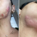 Mulheres acusam dentista de gerar infecções no rosto dela após procedimentos estéticos