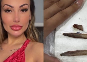 Andressa Urach retira costelas e exibe os ossos no Insta: ‘lindinhas’