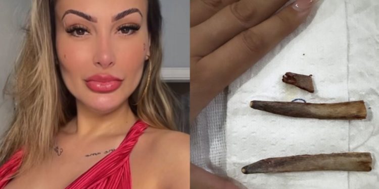 Andressa Urach retira costelas e exibe os ossos no Insta: ‘lindinhas’