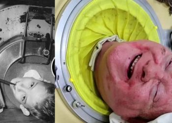 Covid mata homem que viveu 70 anos com “pulmão de ferro”