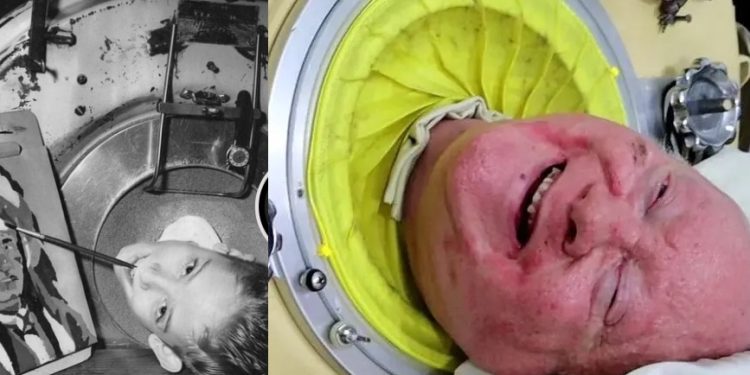 Covid mata homem que viveu 70 anos com “pulmão de ferro”
