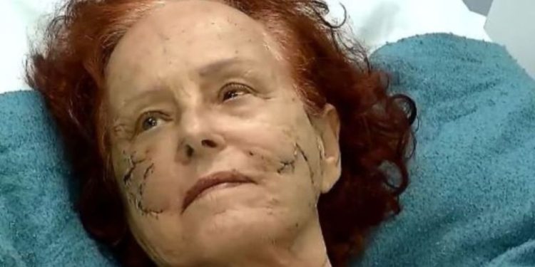Escritora atacada por três pitbulls deixa hospital sob aplausos: ‘guerreira’