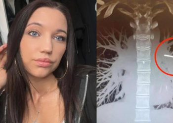 Implante anticoncepcional vai parar em pulmão de mulher