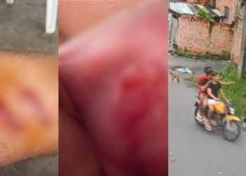 Olho roxo, boca estourada e arranhões no corpo: estudante que foi assaltado no Tancredo Neves ficou cheio de hematomas no corpo