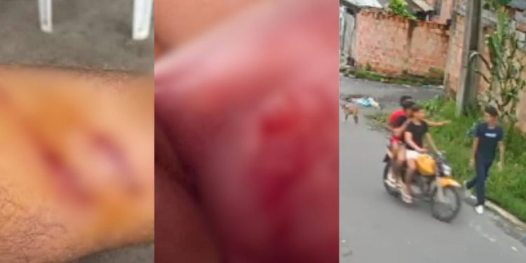 Olho roxo, boca estourada e arranhões no corpo: estudante que foi assaltado no Tancredo Neves ficou cheio de hematomas no corpo