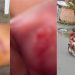 Olho roxo, boca estourada e arranhões no corpo: estudante que foi assaltado no Tancredo Neves ficou cheio de hematomas no corpo