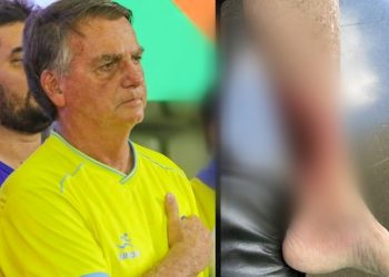 Bactéria na perna mandou Bolsonaro para a Santa Júlia em Manaus