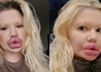 Com boca deformada por plásticas, blogueira recebe alerta dos médicos: ‘vai morrer’