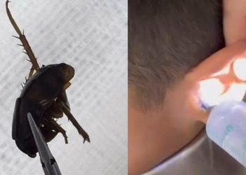 Vídeo: médico faz lavagem no ouvido de paciente entupido  por barata