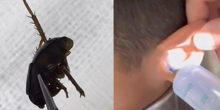 Vídeo: médico faz lavagem no ouvido de paciente entupido  por barata