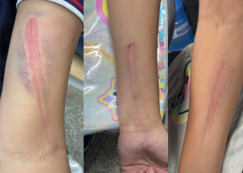 Menina de 12 anos chega toda ‘marcada’ em escola e mã3 e p@dr@sto são suspeitos do crime