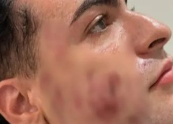 Homem que morreu tentando tratar pele do rosto arregalou os olhos na hora da morte