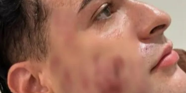 Homem que morreu tentando tratar pele do rosto arregalou os olhos na hora da morte