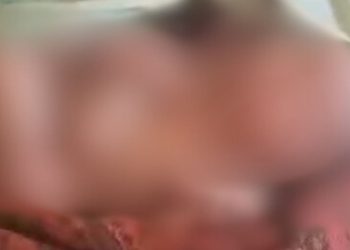 Dois rostos e quatro pernas: bebê bizarro nasce com membros duplicados