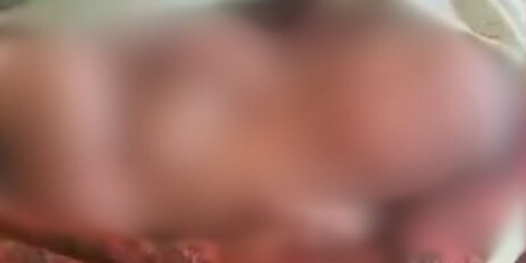 Dois rostos e quatro pernas: bebê bizarro nasce com membros duplicados