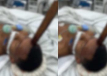 Pedreiro sofre acidente e fica com estaca de madeira enfiada no crânio