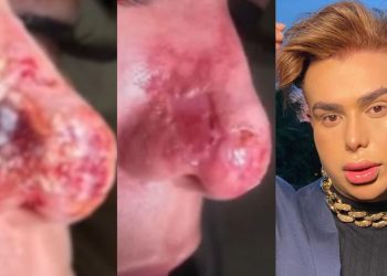 Em Manaus, mulher ameaça dentista que a deixou com o nariz necrosado após procedimento estético: “Tu vai pagar”