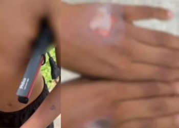 Menino de 11 anos sofre queimaduras após mãe usar chapinha como punição por comer iogurte sem permissão