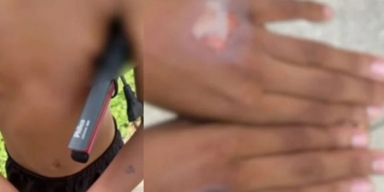 Menino de 11 anos sofre queimaduras após mãe usar chapinha como punição por comer iogurte sem permissão