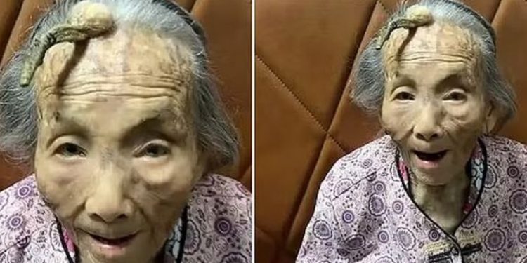 Idosa de 107 anos exibe protuberância na testa e fica famosa do TikTok: ‘chifre da longevidade’