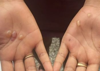 Jovem queimad@ em Manaus jura que não furtou R$ 12 mil