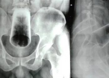 Homem enfia copo no buraco errado e passa por cirurgia