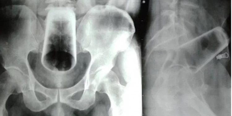 Homem enfia copo no buraco errado e passa por cirurgia
