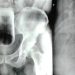 Homem enfia copo no buraco errado e passa por cirurgia