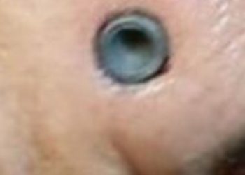 Homem sobrevive após ficar com bala alojada na testa; imagem impressionante