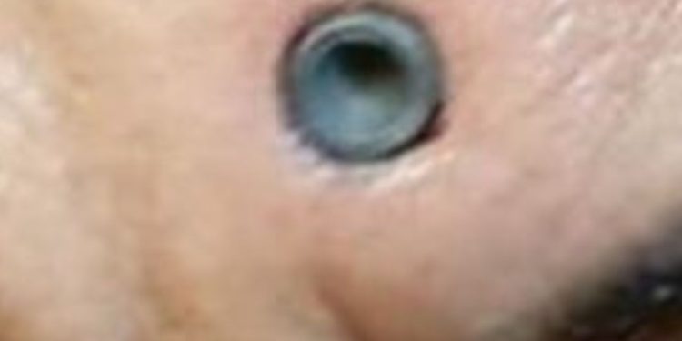 Homem sobrevive após ficar com bala alojada na testa; imagem impressionante