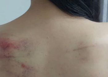 Em Manaus, menina de 10 anos vai ao Conselho Tutelar cheio de hematomas após apanhar da mãe