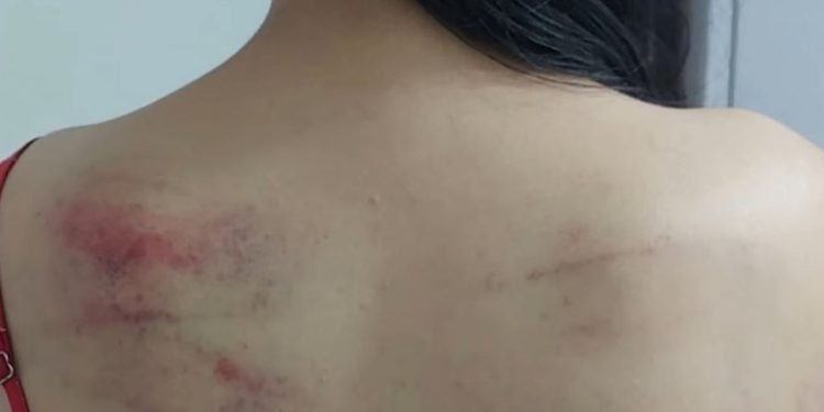 Em Manaus, menina de 10 anos vai ao Conselho Tutelar cheio de hematomas após apanhar da mãe