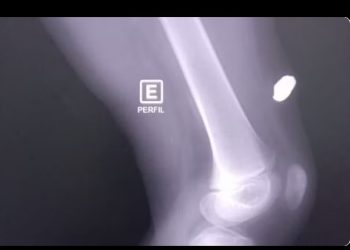 Mãe acorda com barulho de tir0 e encontra filho ferid0 em Itacoatiara