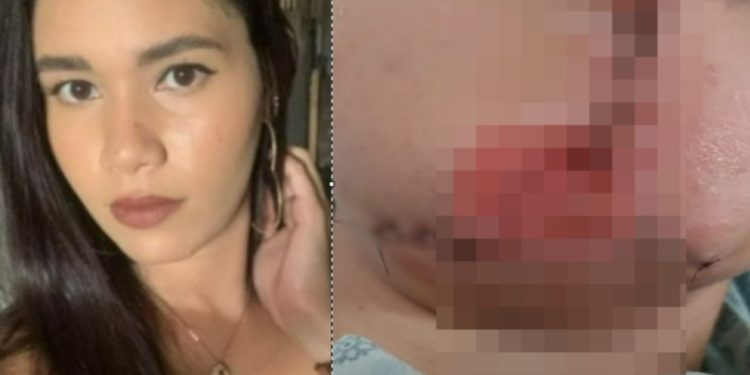 Veja como ficou rosto desfigurad0 de mulher m0rdida pelo namorado: ‘perdeu 50% dos lábios’