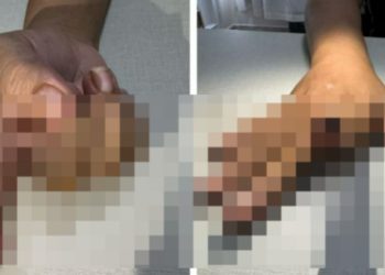 Imagem forte: homem ciumento m0rde e t0ra o dedo da namorada em Manaus