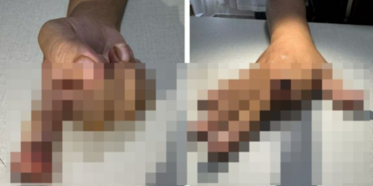 Imagem forte: homem ciumento m0rde e t0ra o dedo da namorada em Manaus