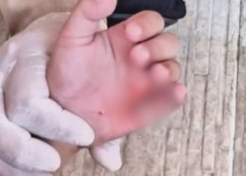 Menino de 6 anos é socorrido após ficar com gancho preso na mão em Manaus