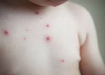 Casos de mpox em escolas de Iranduba são de catapora, esclarece a FVS-RCP