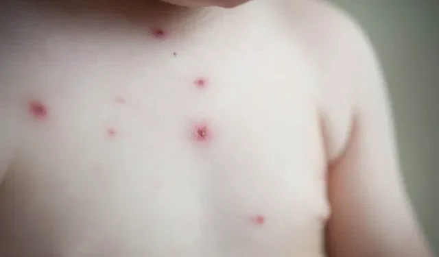 Casos de mpox em escolas de Iranduba são de catapora, esclarece a FVS-RCP