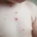 Casos de mpox em escolas de Iranduba são de catapora, esclarece a FVS-RCP