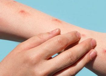 Fundação registra redução de casos de mpox no Amazonas